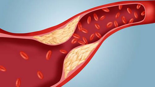 Thuốc lá gây xơ vữa động mạch và nhiều tình trạng nguy hiểm trên tim mạch khác