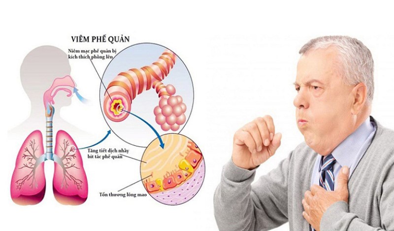 Viêm phế quản mãn tính gây ho đờm