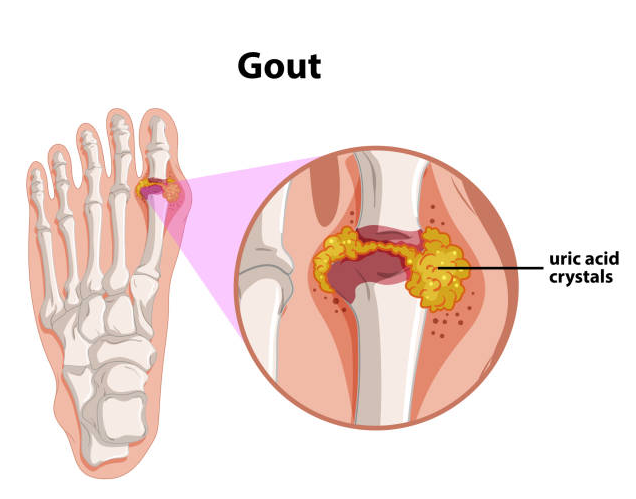 Hạ acid uric trong máu bằng cách nào?