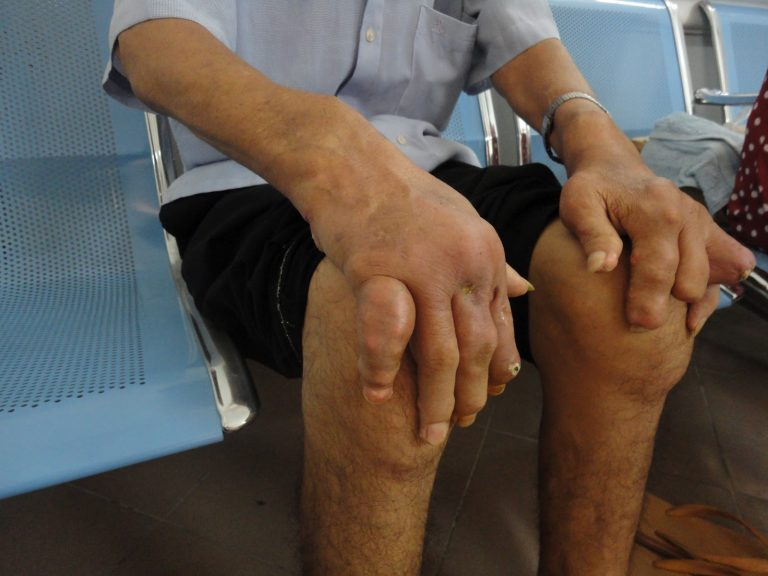 Biến chứng bệnh gút là gì?