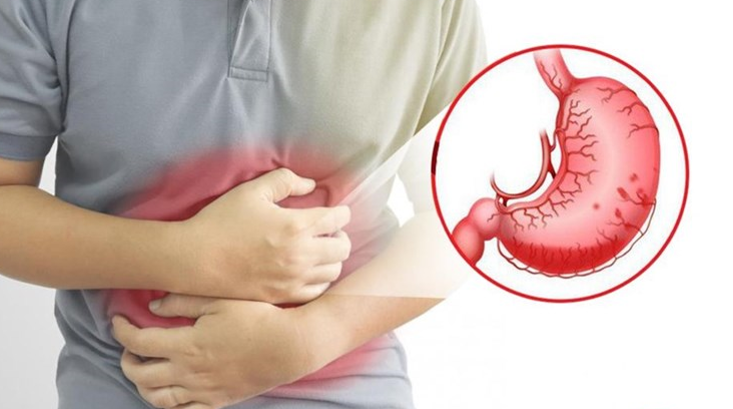 Người bệnh gút sử dụng Allopurinol thường bị đau dạ dày