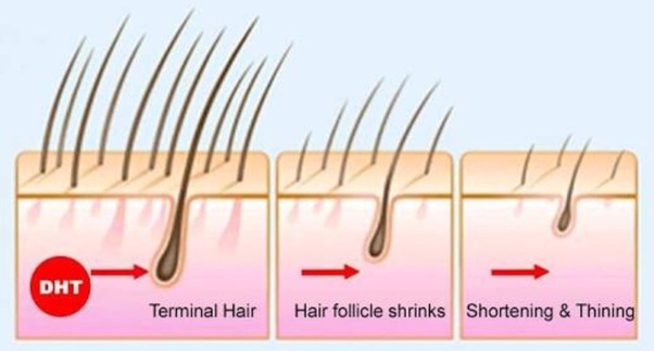 Rụng tóc ở nam giới do nguyên nhân nội tiết