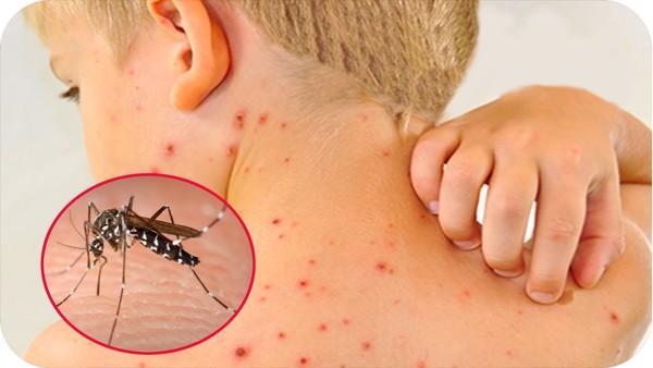 Trẻ nhỏ thường bị sốt xuất huyết vào mùa hè