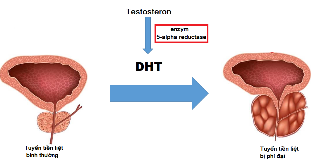 Enzyme 5-alpha reductase tăng tổng hợp DHT gây phì đại tuyến tiền liệt