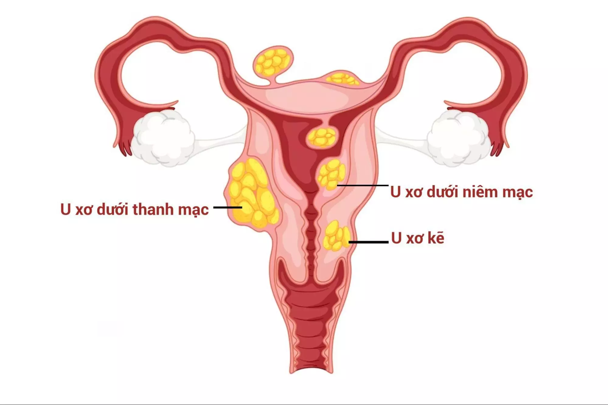 Các loại u xơ tử cung