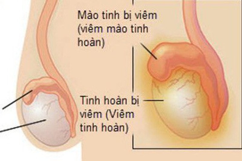 Viêm mào tinh hoàn có thể lan sang gây viêm tinh hoàn