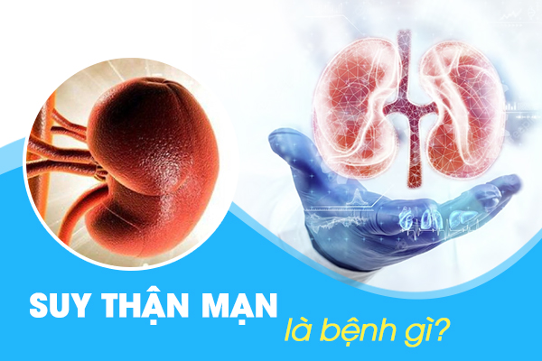 Suy thận mạn là bệnh gì? Nguyên nhân, triệu chứng và cách điều trị