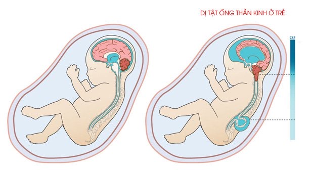 Acid folic giúp ngăn ngừa dị tật ống thần kinh