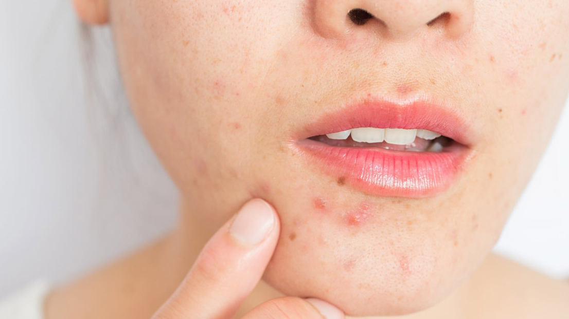 Dùng dầu tẩy trang không đúng cách có thể gây mụn