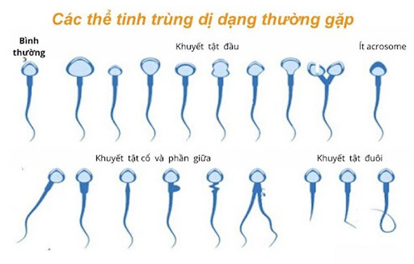 Các dạng tinh trùng dị dạng thường gặp.