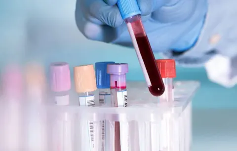 Xét nghiệm máu trong chẩn đoán viêm đại tràng