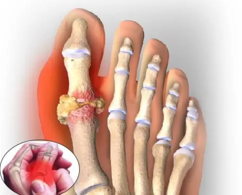 Acid uric máu tăng cao gây ra cơn gút cấp và biến chứng nguy hiểm