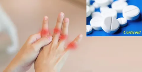 Corticoid giúp giảm đau nhanh chóng trong cơn gút cấp
