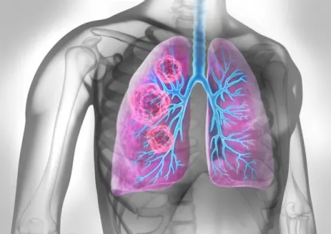 Người bị viêm phế quản mãn tính có nguy cơ cao mắc ung thư phổi