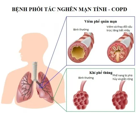 Mối liên quan giữa viêm phế quản mãn tính và bệnh phổi tắc nghẽn mạn tính COPD