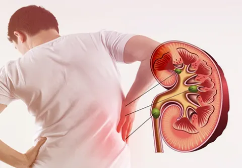 Sỏi tiết niệu gây đau buốt, khi đi tiểu