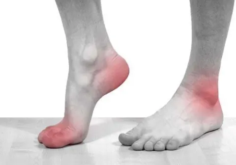 Cơn gút cấp thường khởi phát ở các khớp chi dưới