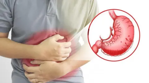 Người bệnh gút sử dụng Allopurinol thường bị đau dạ dày