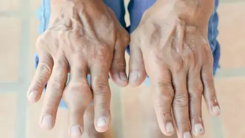 Hạt tophi xuất hiện nhiều khiến nam giới bị đau đớn khi quan hệ.