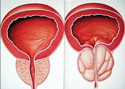 Phì đại tuyến tiền liệt (bên phải) gây bí tiểu ở nam giới ngoài 40 tuổi trở lên