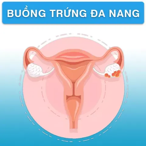 Hội chứng buồng trứng đa nang - bạn biết gì về căn bệnh này?