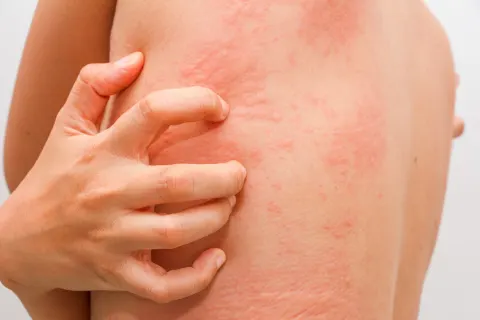 Xuất hiện dưới dạng các mảng da nhiều màu