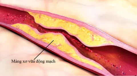 Xơ vữa động mạch là nguyên nhân chính gây ra biến chứng mạch máu lớn
