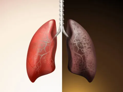 Nhiễm độc phổi là căn nguyên hình thành các bệnh lý mãn tính ở phổi