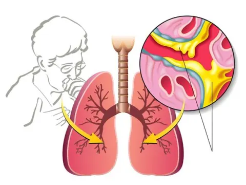 Ho, đờm, khó thở lâu ngày không hết - Giải pháp khắc phục an toàn và hiệu quả