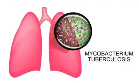Lao phổi là bệnh do vi khuẩn Mycobacterium tuberculosis gây nên ở phổi của người bệnh