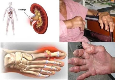 Biến chứng trên khớp và trên thận của bệnh gút