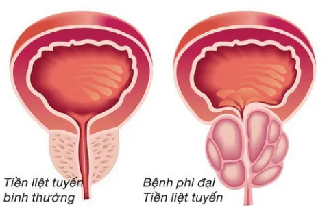 Phì đại tuyến tiền liệt có nguy hiểm không?