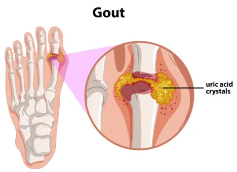 Acid uric tăng cao là thủ phạm hình thành bệnh gout
