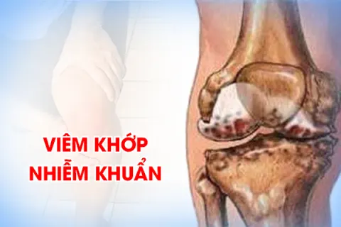 Viêm khớp nhiễm khuẩn - Những thông tin mà bạn cần biết về căn bệnh này!