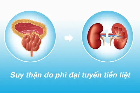 Mách bạn các biện pháp giúp phòng ngừa biến chứng suy thận do phì đại tuyến tiền liệt
