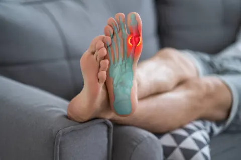 Cảnh báo: Bạn có thể bị viêm khớp mạn tính do chủ quan về bệnh gút
