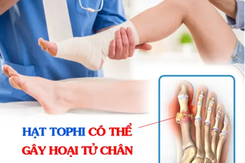 Hạt tophi có thể gây hoại tử chân