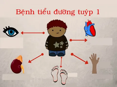 Tiểu đường tuýp 1 thường liên quan đến yếu tố di truyền