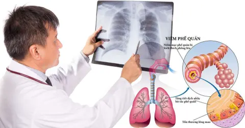 Viêm phế quản cấp có trị hết được không?