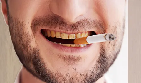 Răng ố vàng - Tác hại của thuốc lá bạn nên khắc phục sớm