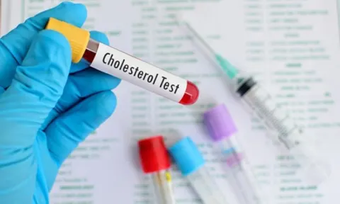 Xét nghiệm giữ vai trò quan trọng trong chẩn đoán rối loạn chuyển hóa lipid máu