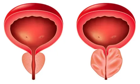 Phì đại tuyến tiền liệt là nguyên nhân hàng đầu gây tiểu nhiều lần ở nam giới