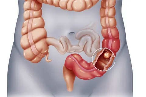 Viêm đại tràng mãn tính có thể tiến triển thành ung thư