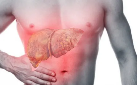 Xơ gan là gì? Bệnh xơ gan có chữa được không?