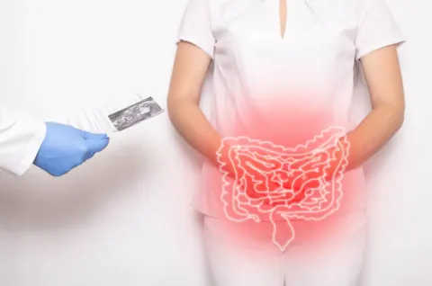  Viêm đại tràng mãn tính cũng là nguyên nhân gây rối loạn đại tiện