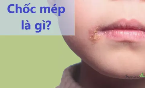 Tất tần tật những điều cần biết về bệnh chốc mép (lở mép)