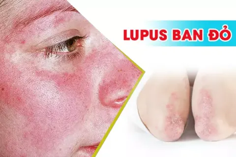 Lupus ban đỏ - Nguyên nhân, triệu chứng và cách điều trị