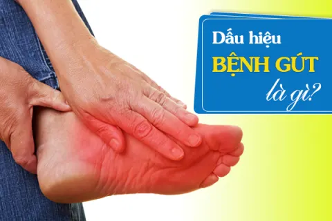Đừng chủ quan khi bạn có 3 dấu hiệu bệnh gút sau đây