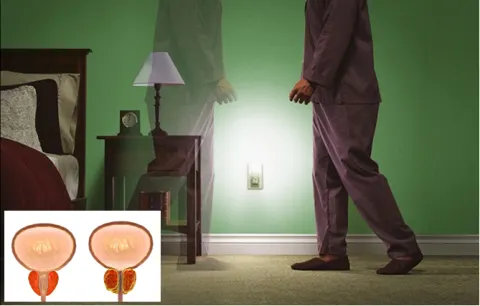 Tiểu đêm nhiều lần ở nam giới do phì đại tuyến tiền liệt - Đừng chủ quan!