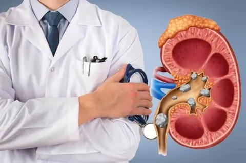 Bệnh nhân gút khi sử dụng Allopurinol cần đi kiểm tra chức năng thận thường xuyên